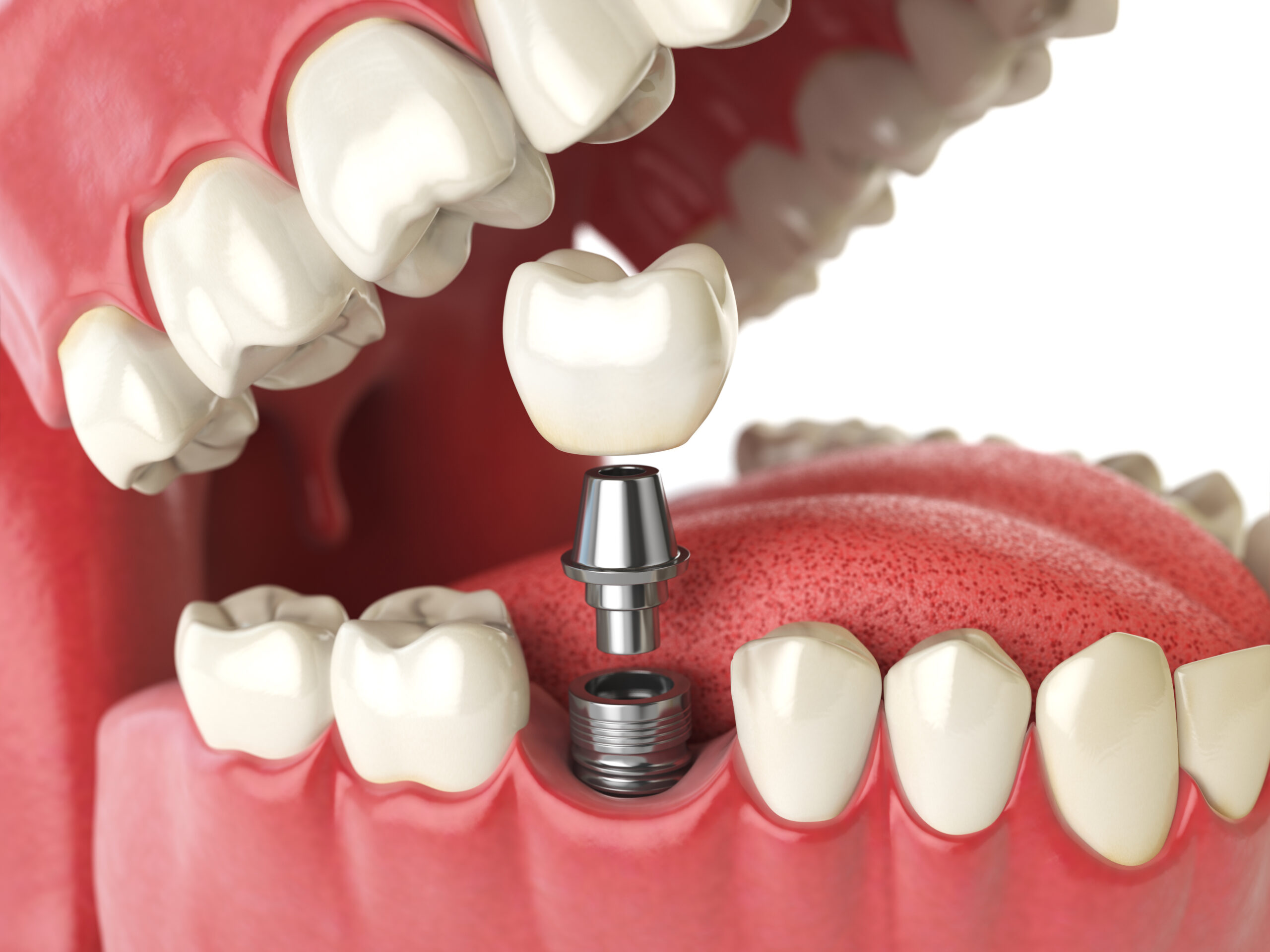 implant dentaire stabilite long terme scaled Pose de la couronne sur implant Apolline Dental Care | Cabinet Dentaire Spécialisé