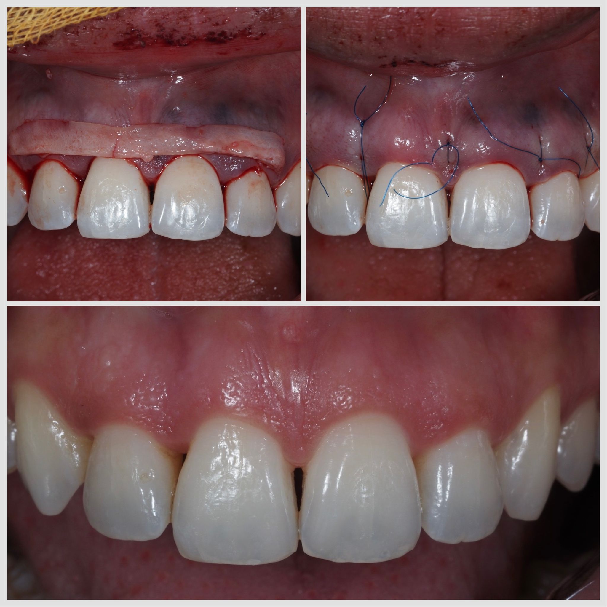 Greffe conjonctive réalisée par technique tunnelisée pour traiter une récession gingivale à Apolline Dental Care à Corbeil-Essonnes