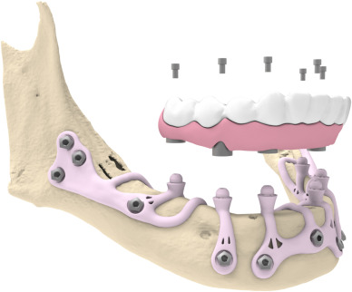 1 s2 0 s1010518225000149 gr1 1 s2 0 s1010518225000149 gr1 Implants sous-périostés Dentistes Essonne | Apolline Dental Care
