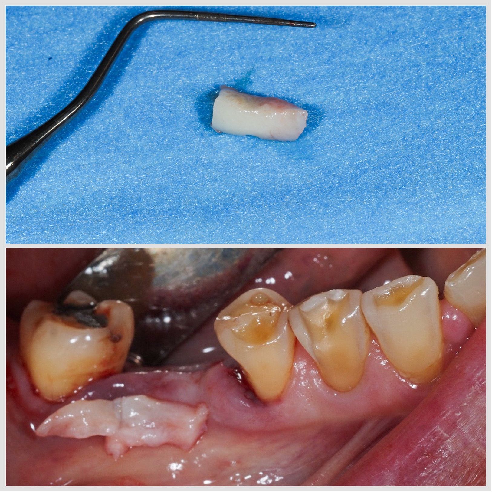 Greffe conjonctive réalisée autour d’un implant pour renforcer les tissus mous et améliorer le profil d’émergence à Apolline Dental Care à Corbeil-Essonnes