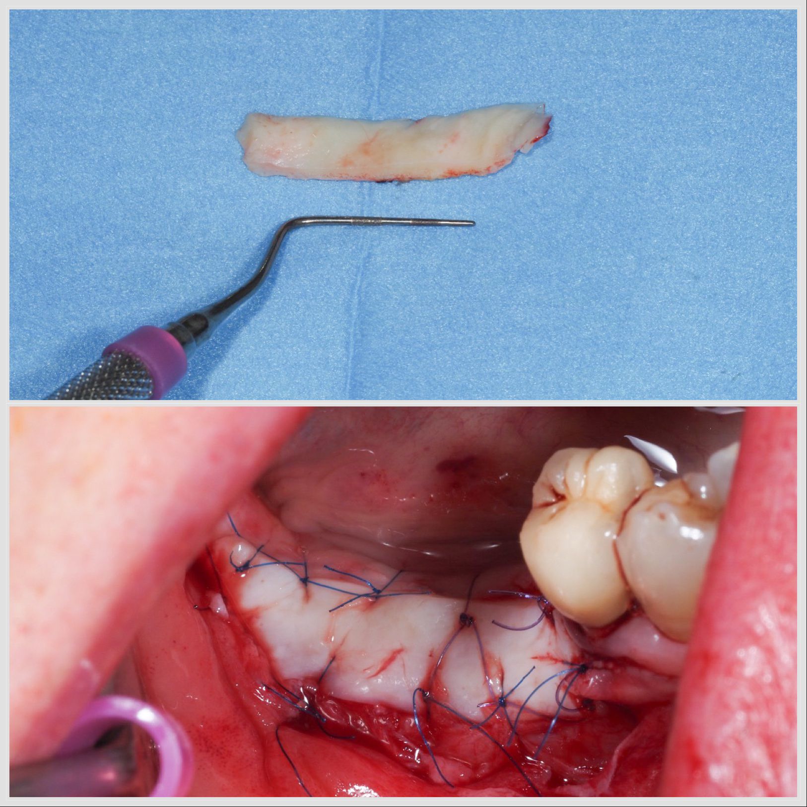 Greffe gingivale libre réalisée pour augmenter la gencive et protéger la dent à Apolline Dental Care à Corbeil-Essonnes