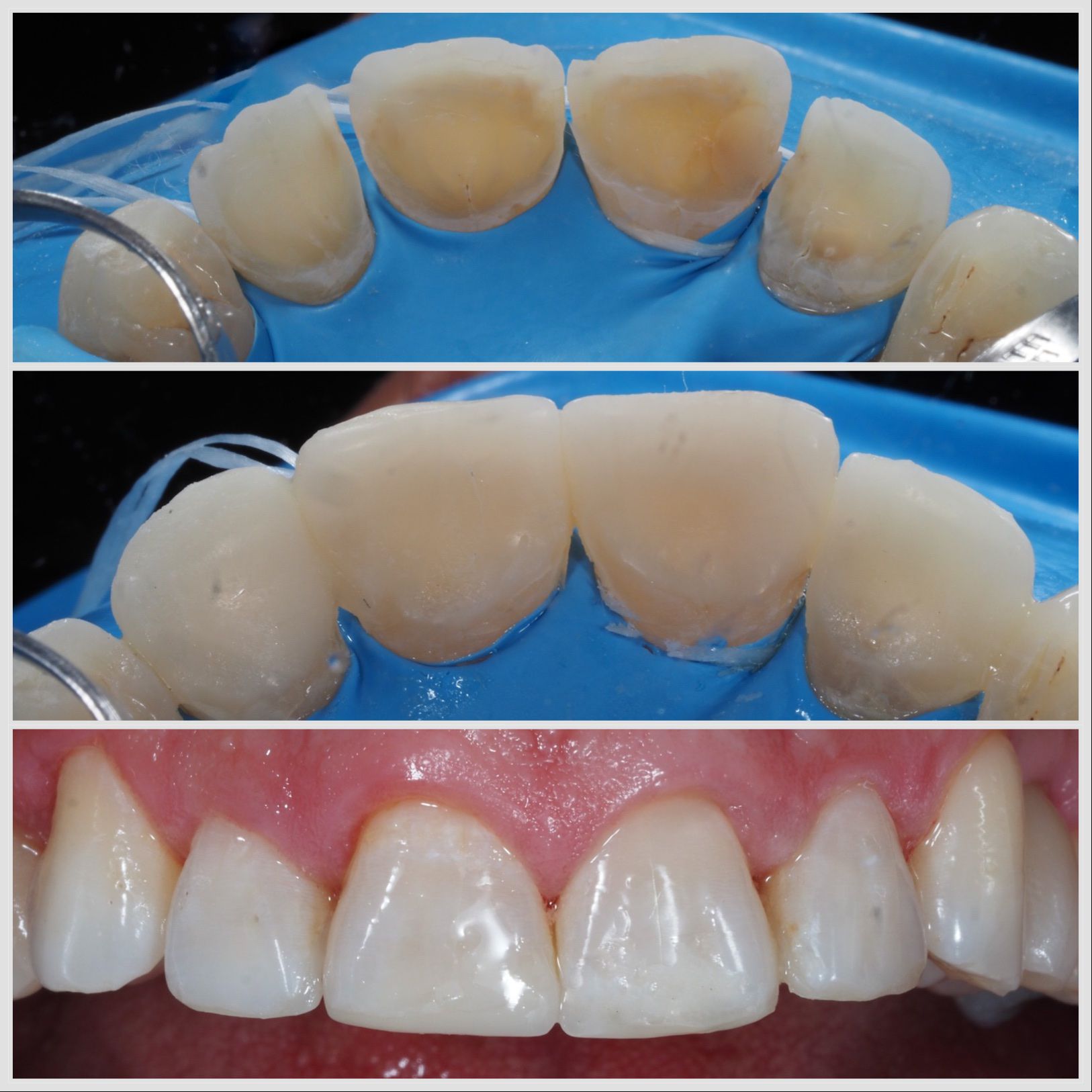 Facette palatine utilisée pour restaurer une dent érodée à Apolline Dental Care à Corbeil-Essonnes