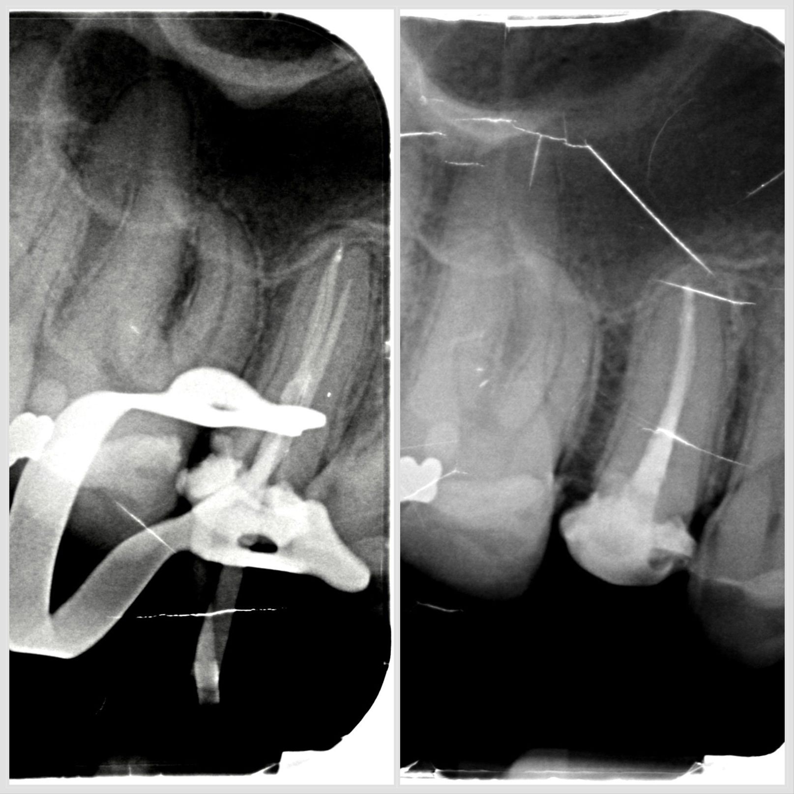 Traitement endodontique sur prémolaire avec trois canaux réalisé à Apolline Dental Care à Corbeil-Essonnes