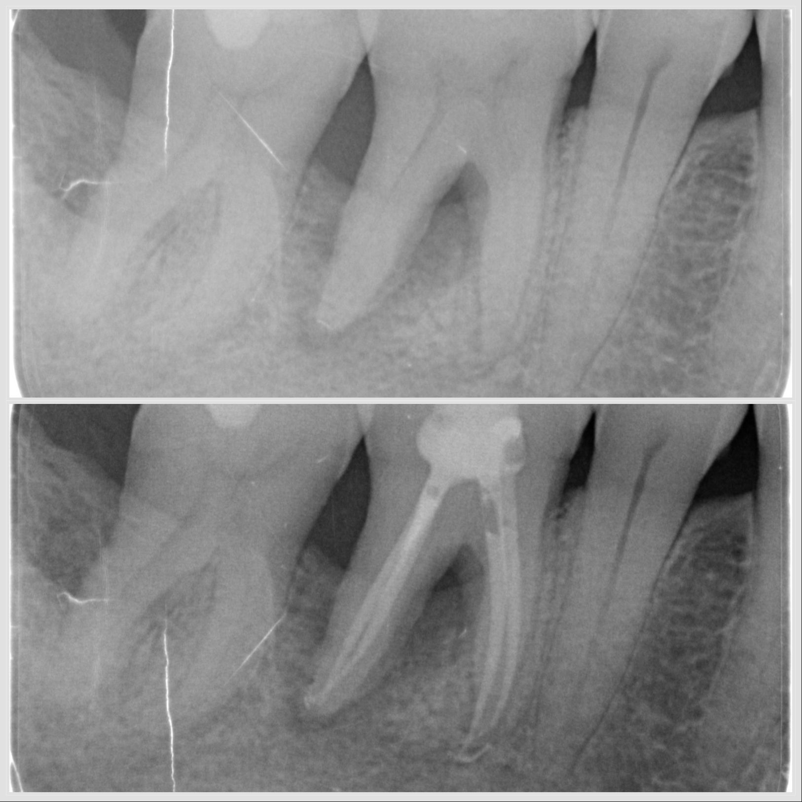 Lésion endo-parodontale sur molaire mandibulaire traitée en endodontie et parodontologie à Apolline Dental Care à Corbeil-Essonnes