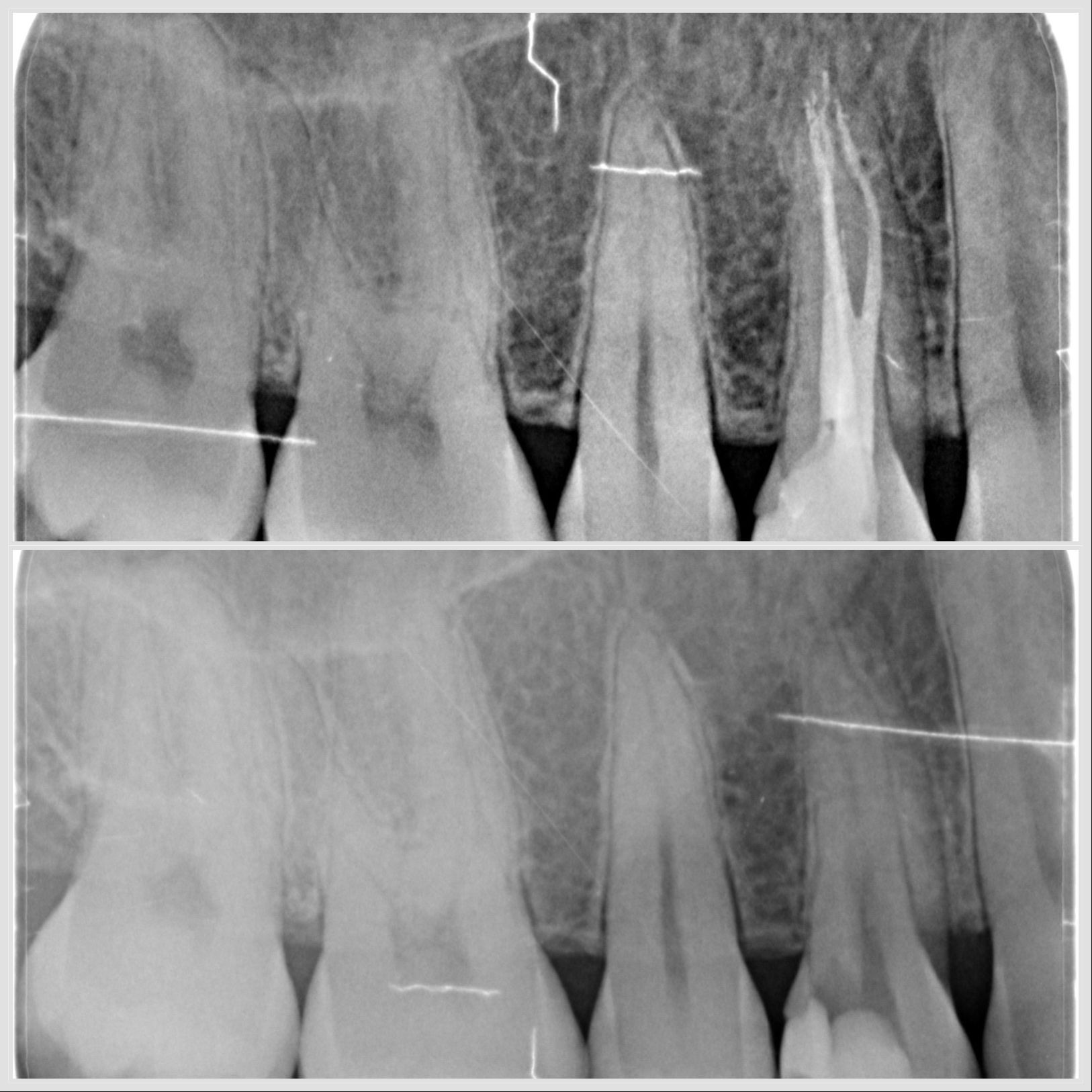 Prémolaire mandibulaire avec trois canaux traitée sous microscope à Apolline Dental Care à Corbeil-Essonnes