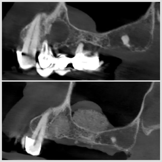 Extraction dentaire avec ablation de kyste et sinus lift réalisé à Apolline Dental Care à Corbeil-Essonnes