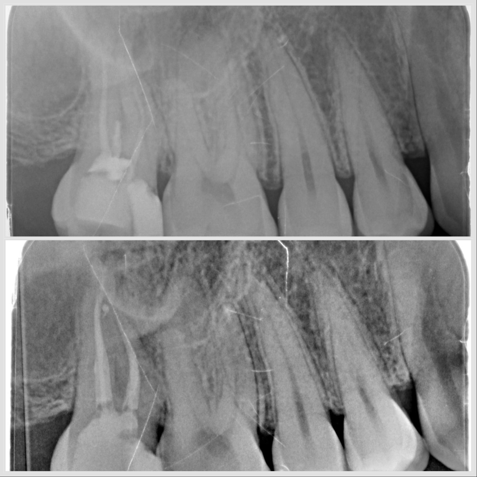 Traitement endodontique d’une molaire maxillaire nécrosée réalisé à Apolline Dental Care à Corbeil-Essonnes