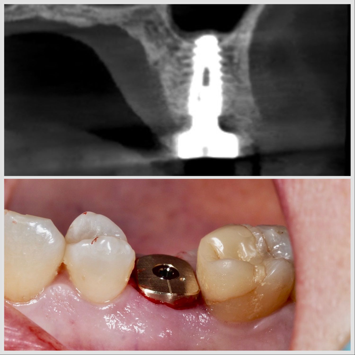 Pose d’un implant selon la technique Summers avec élévation du sinus par voie crestale à Apolline Dental Care à Corbeil-Essonnes