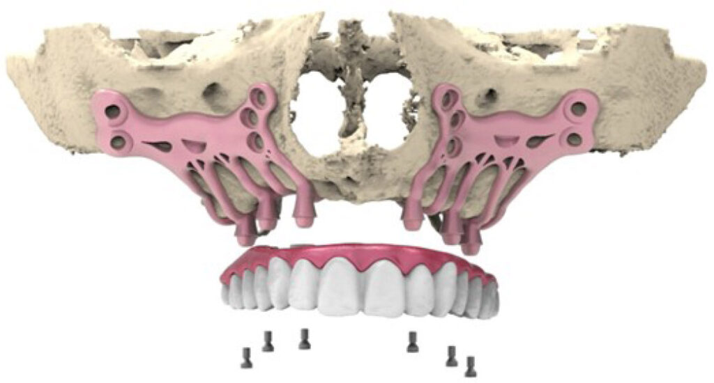 images rcsfdj 2025 9 03 images rcsfdj 2025 9 03 Implants sous-périostés Dentistes Essonne | Apolline Dental Care