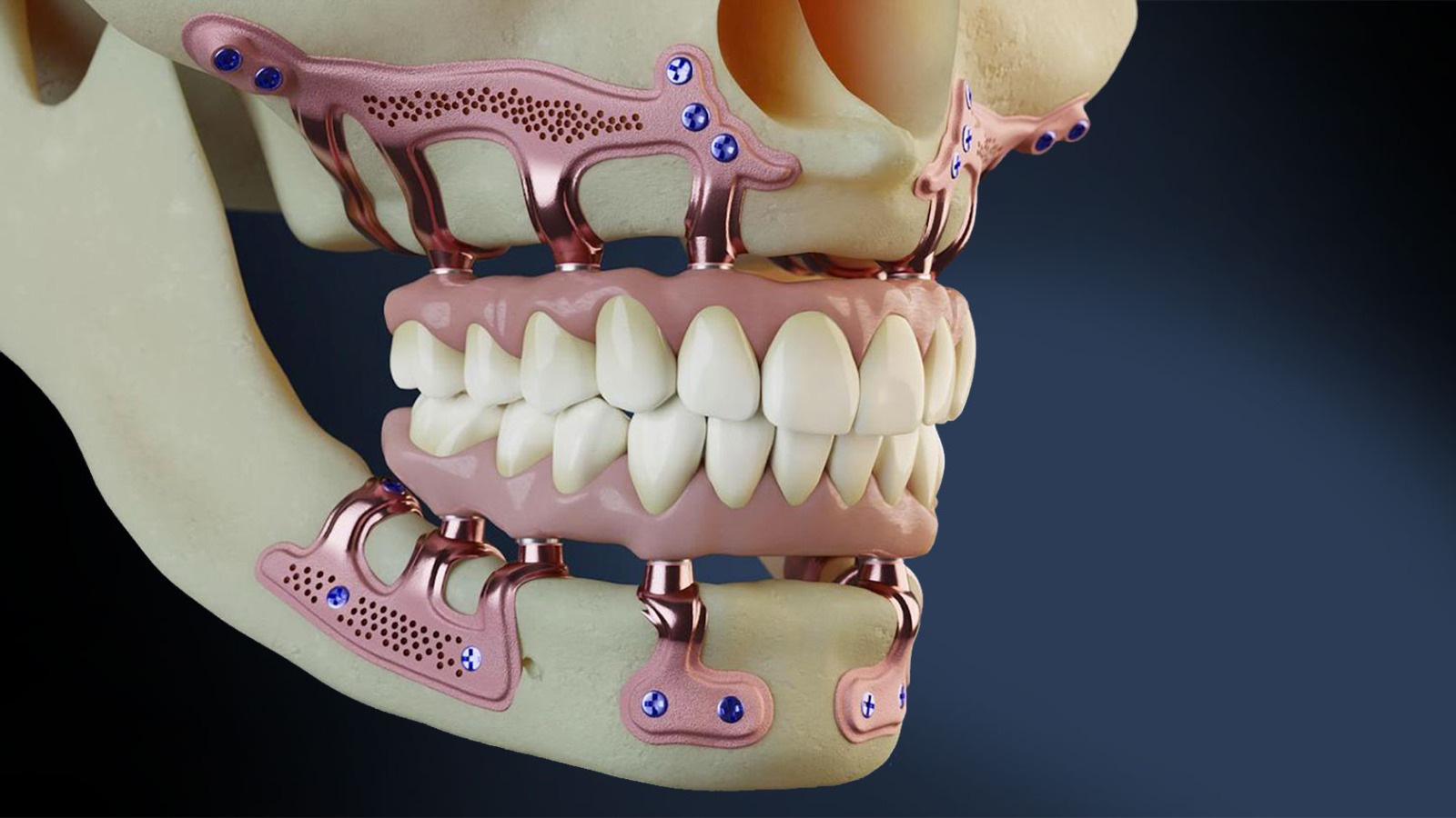 Implant sous-périosté posé en alternative à la greffe osseuse pour restaurer une mâchoire atrophiée à Apolline Dental Care à Corbeil-Essonnes