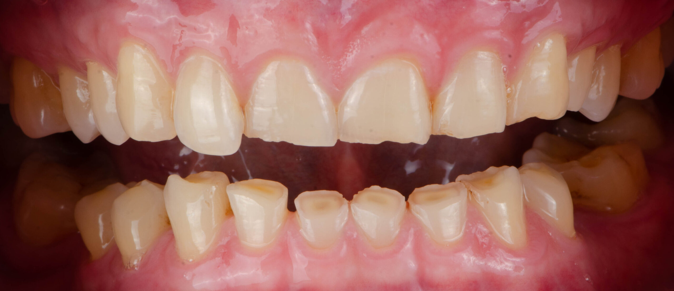 appoline dental care cabinet dentaire scaled Usure et Érosion Dentaire : Causes, Symptômes et Traitements Apolline Dental Care | Cabinet Dentaire Spécialisé