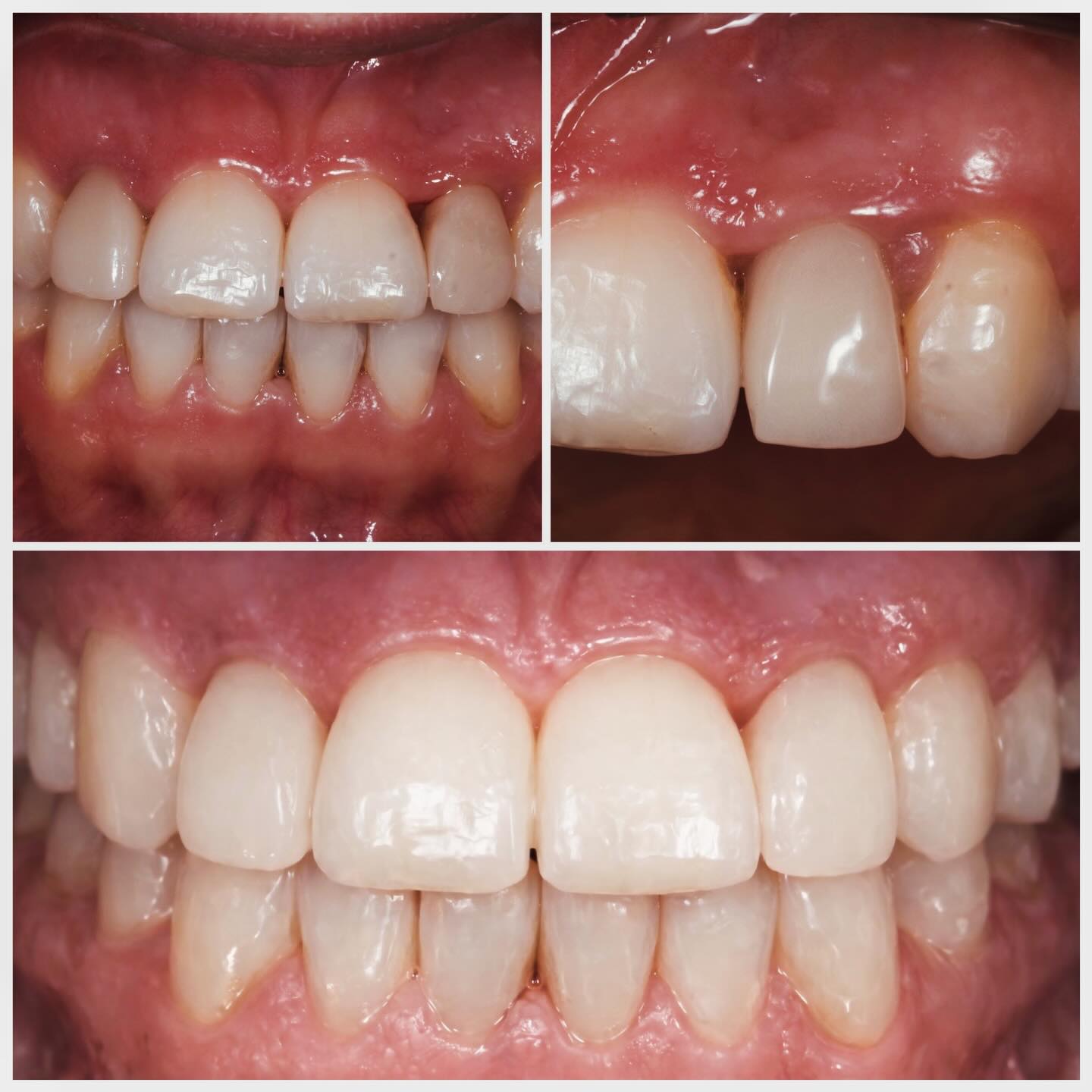 agénésie des incisives latérales : implants après orthodontie Agénésie des incisives latérales : implants après orthodontie Apolline Dental Care | Cabinet Dentaire Spécialisé