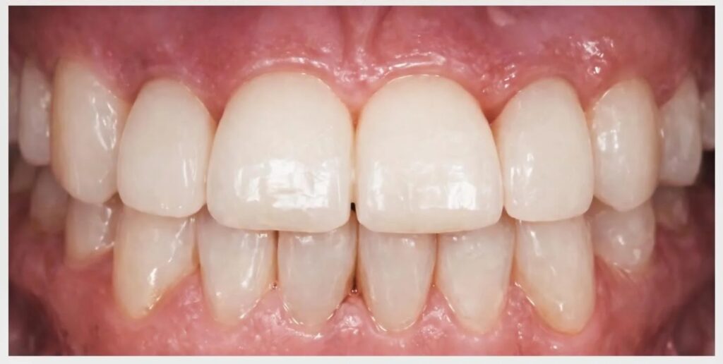 Agénésie des incisives latérales : implants après orthodontie — cas clinique realise au cabinet Apolline Dental Care a Corbeil-Essonnes