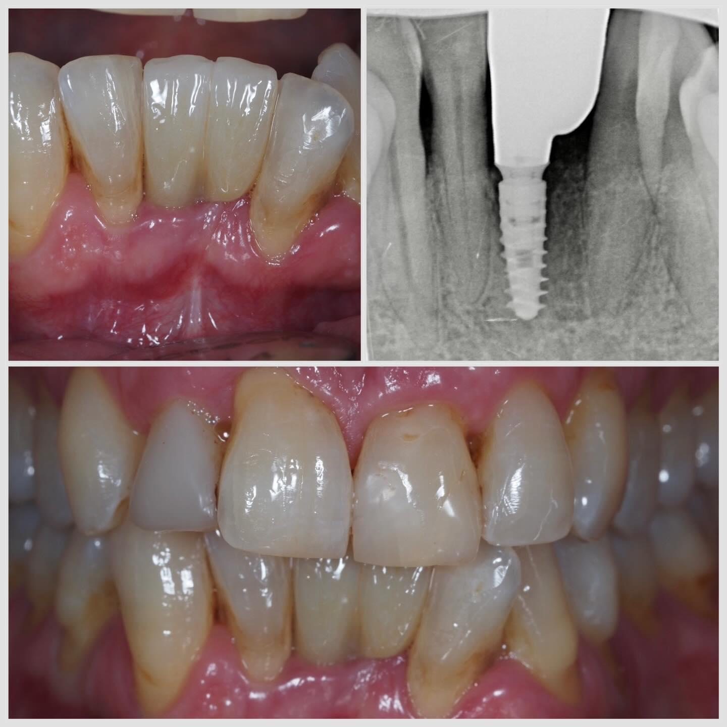 un implant pour deux incisives : bridge cantilever implanto porté Un implant pour deux incisives Apolline Dental Care | Cabinet Dentaire Spécialisé