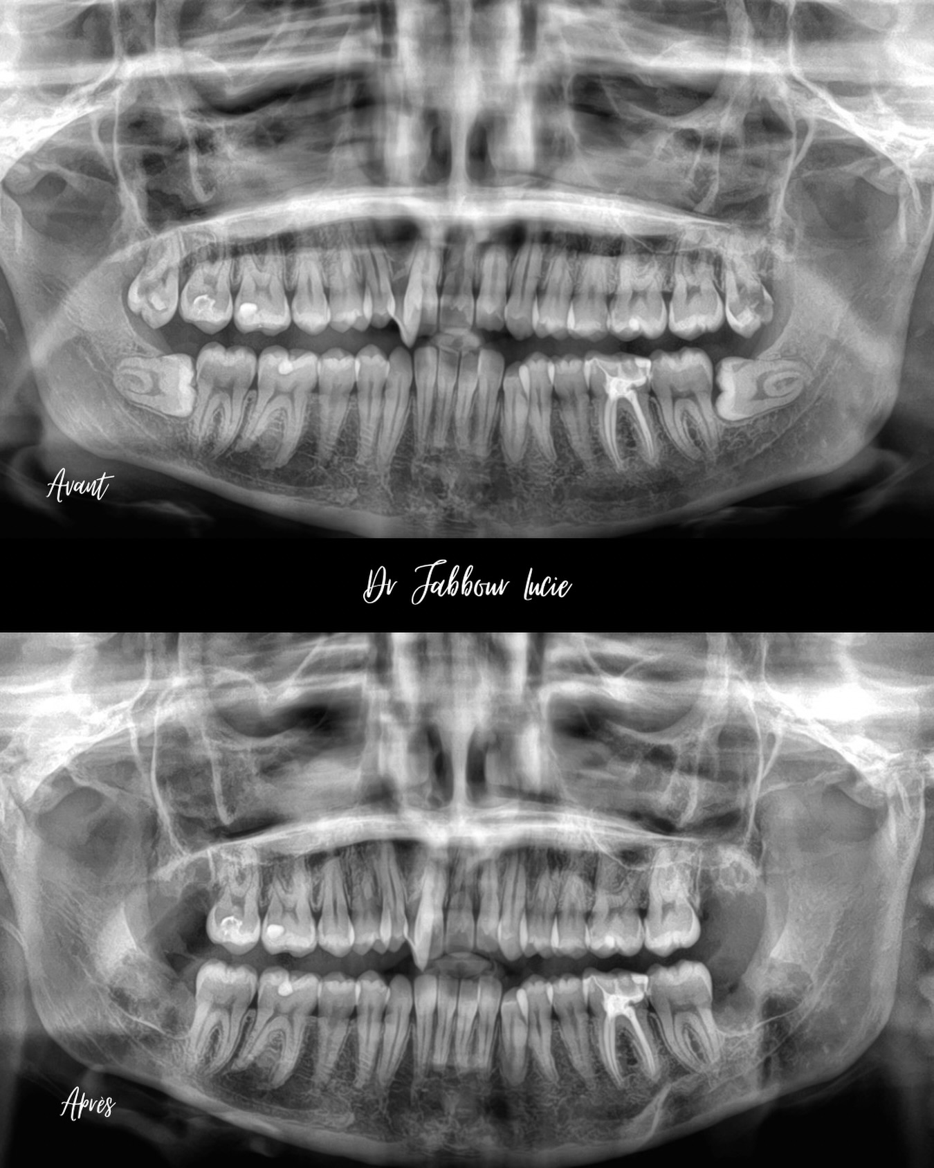 dents de sagesse incluses au contact du nerf Dents de sagesse incluses au contact du nerf Apolline Dental Care | Cabinet Dentaire Spécialisé