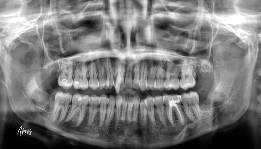 Dents de sagesse incluses au contact du nerf — cas clinique realise au cabinet Apolline Dental Care a Corbeil-Essonnes