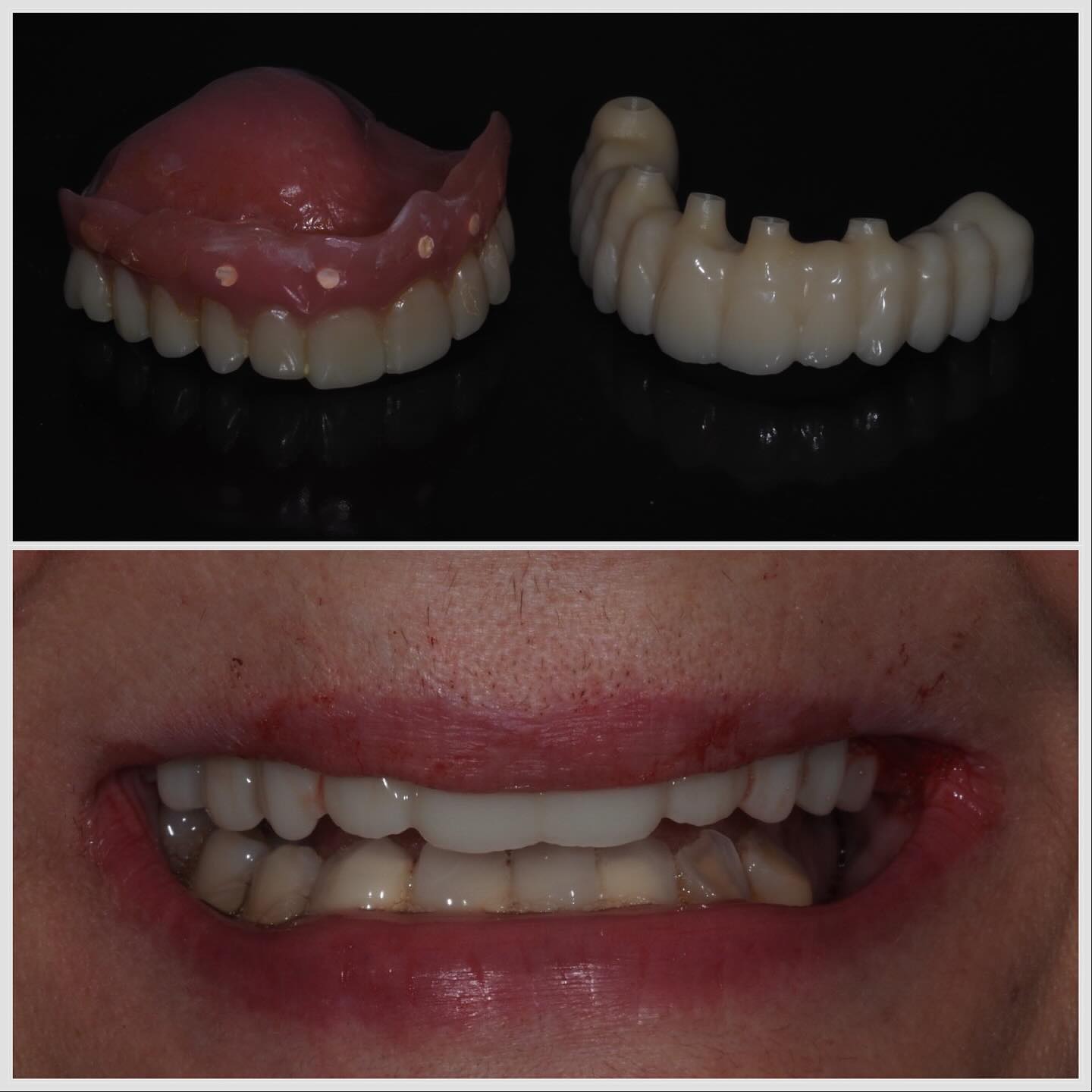 du dentier amovible au bridge fixe sur implants Bridge sur implants Apolline Dental Care | Cabinet Dentaire Spécialisé