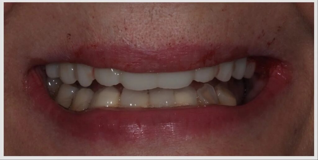 Du dentier amovible au bridge fixe sur implants — cas clinique realise au cabinet Apolline Dental Care a Corbeil-Essonnes