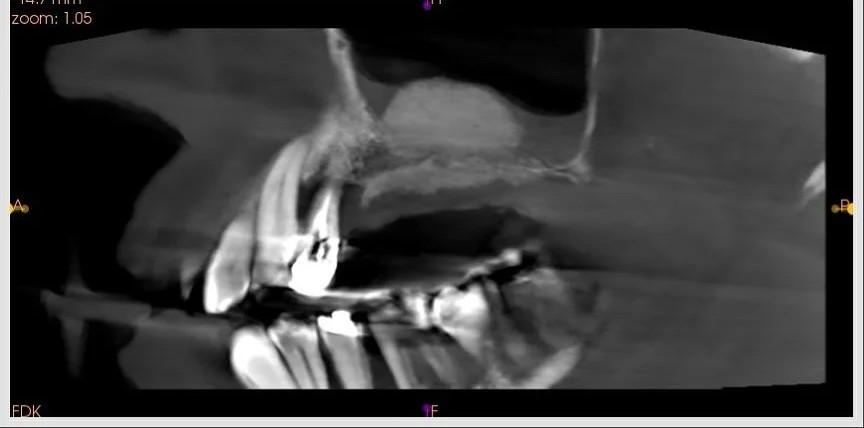 Élévation sinusienne et curetage d'un kyste résiduel — cas clinique realise au cabinet Apolline Dental Care a Corbeil-Essonnes
