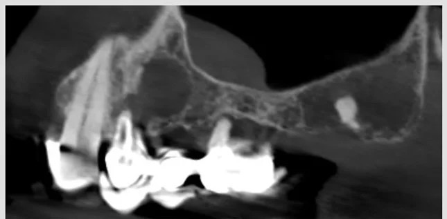 Extraction de piliers de bridge fracturés et préparation implantaire — cas clinique realise au cabinet Apolline Dental Care a Corbeil-Essonnes