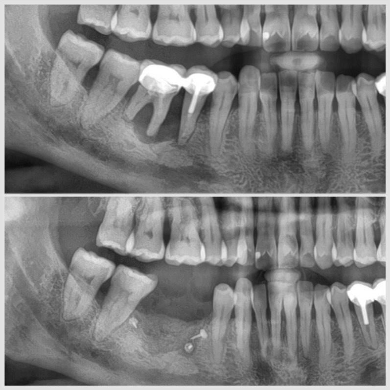 extraction et reconstruction osseuse d un large défaut Extraction et reconstruction osseuse d'un large défaut Apolline Dental Care | Cabinet Dentaire Spécialisé