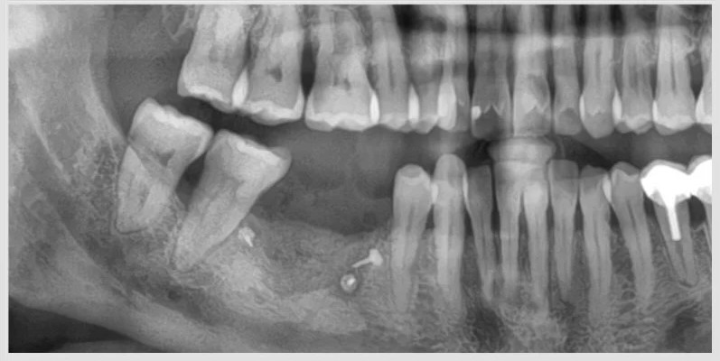Extraction et reconstruction osseuse d'un large défaut — cas clinique realise au cabinet Apolline Dental Care a Corbeil-Essonnes