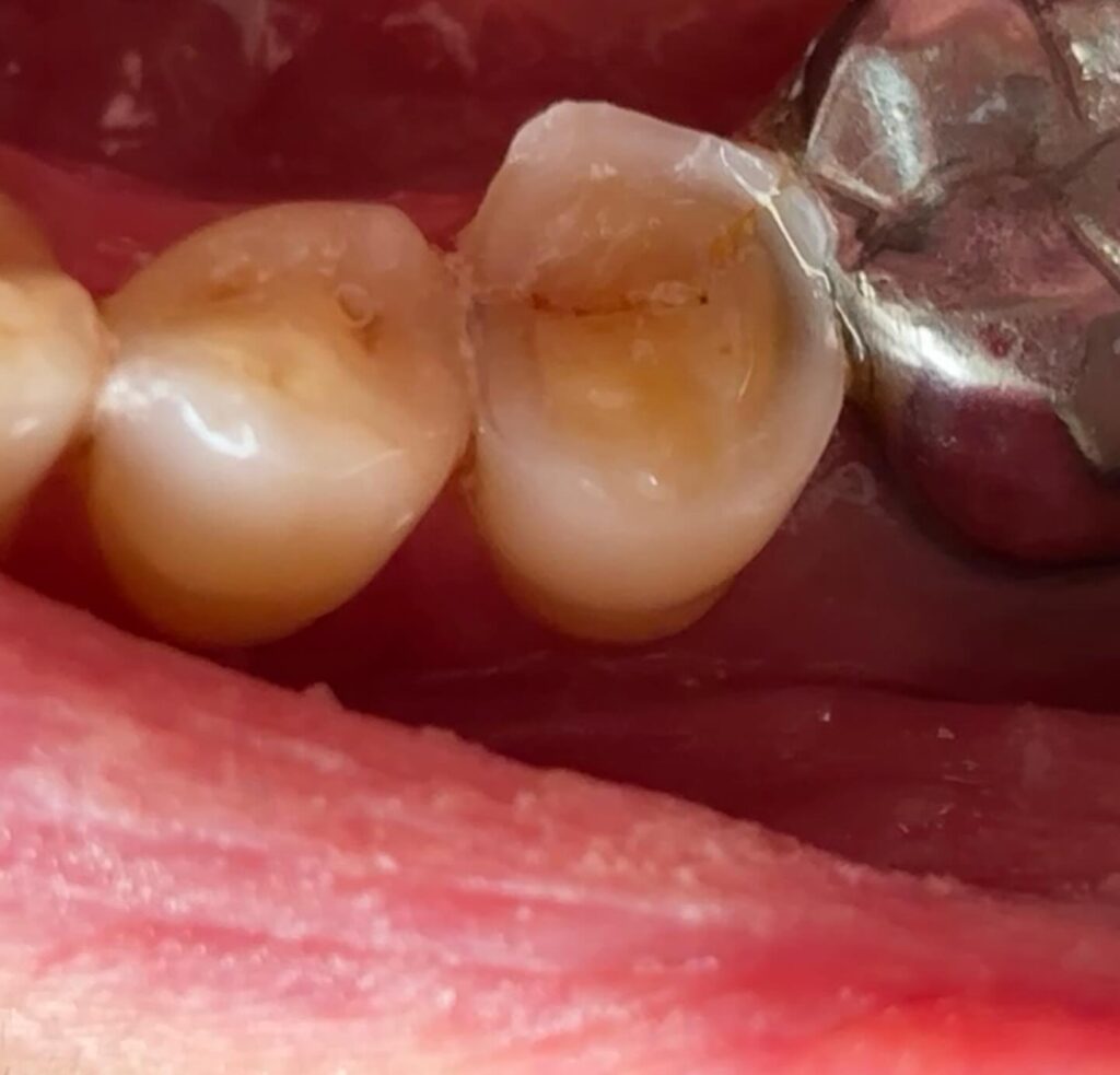 une douleur inexpliquée : la fêlure dentaire Fêlure dentaire Apolline Dental Care | Cabinet Dentaire Spécialisé