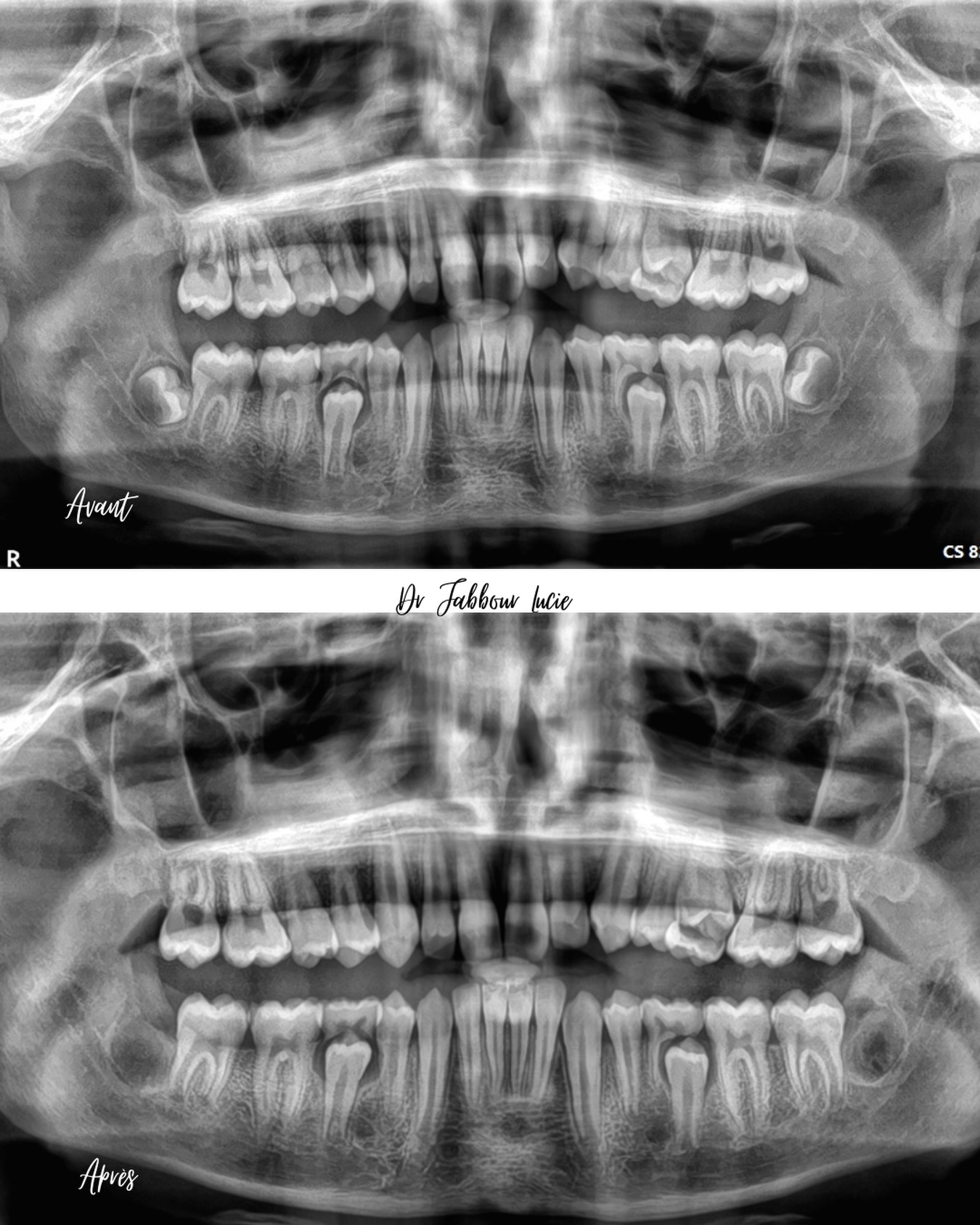 germectomie chez un adolescent Germectomie chez un adolescent Apolline Dental Care | Cabinet Dentaire Spécialisé