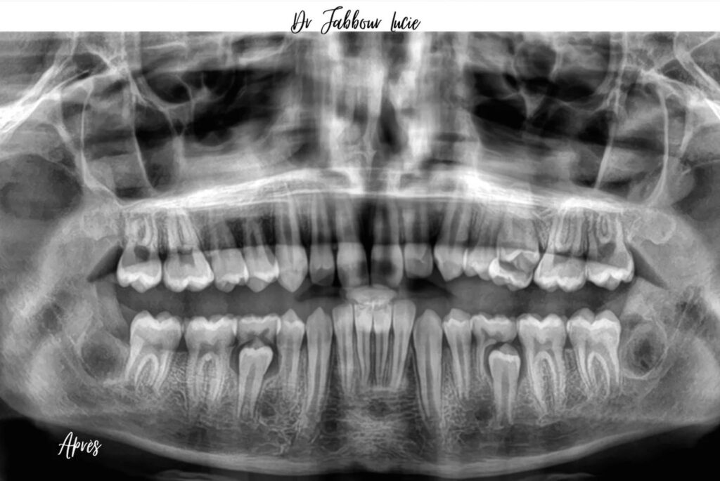 Germectomie chez un adolescent — cas clinique realise au cabinet Apolline Dental Care a Corbeil-Essonnes