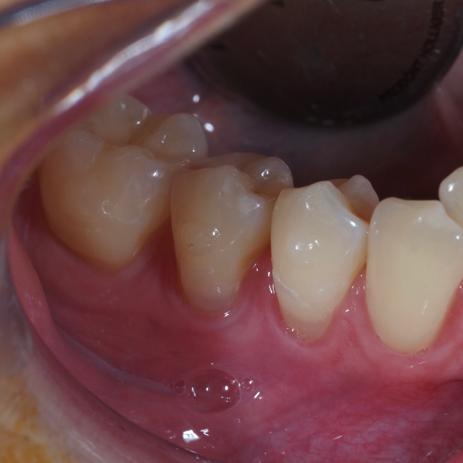 greffe de conjonctif par tunnelisation Tunnelisation Apolline Dental Care | Cabinet Dentaire Spécialisé