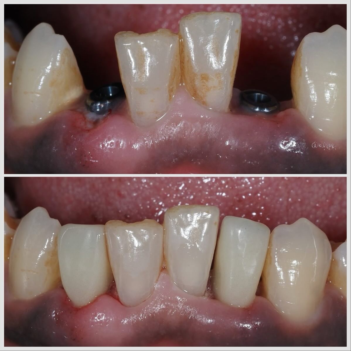 implant étroit sur une incisive latérale fracturée Implant étroit sur une incisive latérale fracturée Apolline Dental Care | Cabinet Dentaire Spécialisé