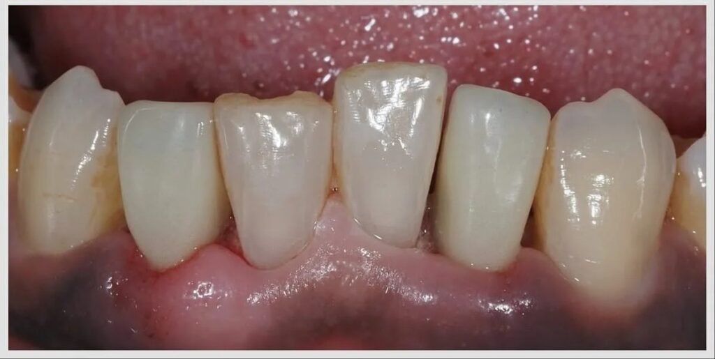 Implant étroit sur une incisive latérale fracturée — cas clinique realise au cabinet Apolline Dental Care a Corbeil-Essonnes