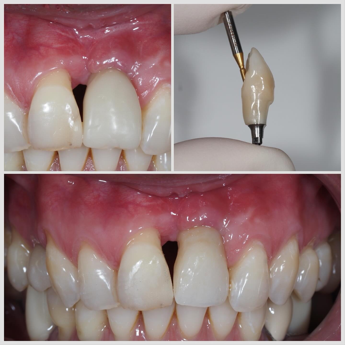 implant sur incisive centrale : reconstruire l os la gencive et l harmonie Implant sur incisive centrale : reconstruire l'os, la gencive et l'harmonie Apolline Dental Care | Cabinet Dentaire Spécialisé