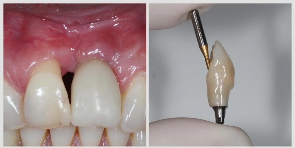 Implant sur incisive centrale : reconstruire l'os, la gencive et l'harmonie — cas clinique realise au cabinet Apolline Dental Care a Corbeil-Essonnes