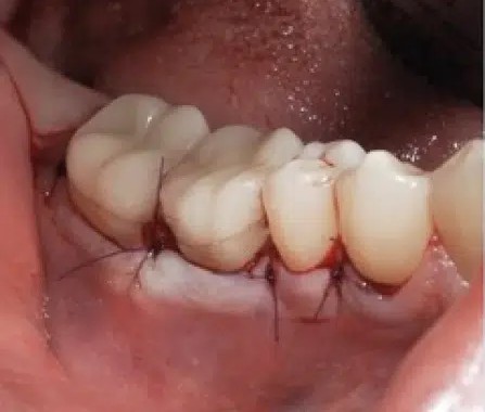 Lésion intra-osseuse — cas clinique réalisé au cabinet Apolline Dental Care à Corbeil-Essonnes