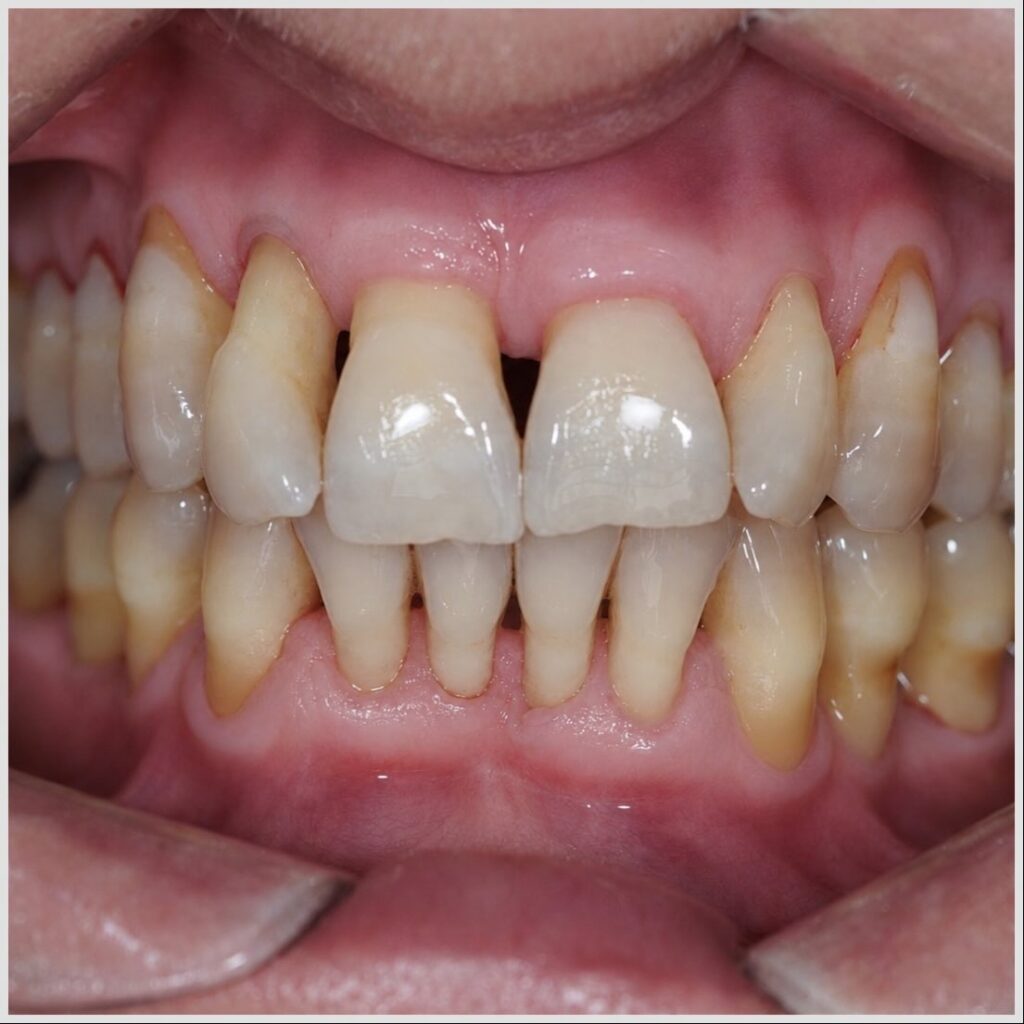 parodontite sévère stabilisée : un parodonte réduit mais sain Parodontite sévère stabilisée Apolline Dental Care | Cabinet Dentaire Spécialisé