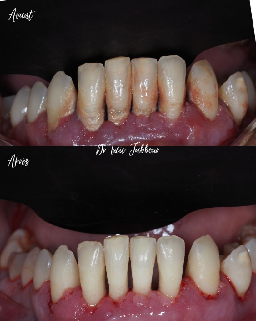 parodontite aggravée par le tabac et le diabète Parodontite et le diabète Apolline Dental Care | Cabinet Dentaire Spécialisé