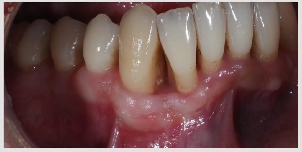 Une poche de 15 mm : traiter la lésion osseuse et renforcer la gencive — cas clinique realise au cabinet Apolline Dental Care a Corbeil-Essonnes