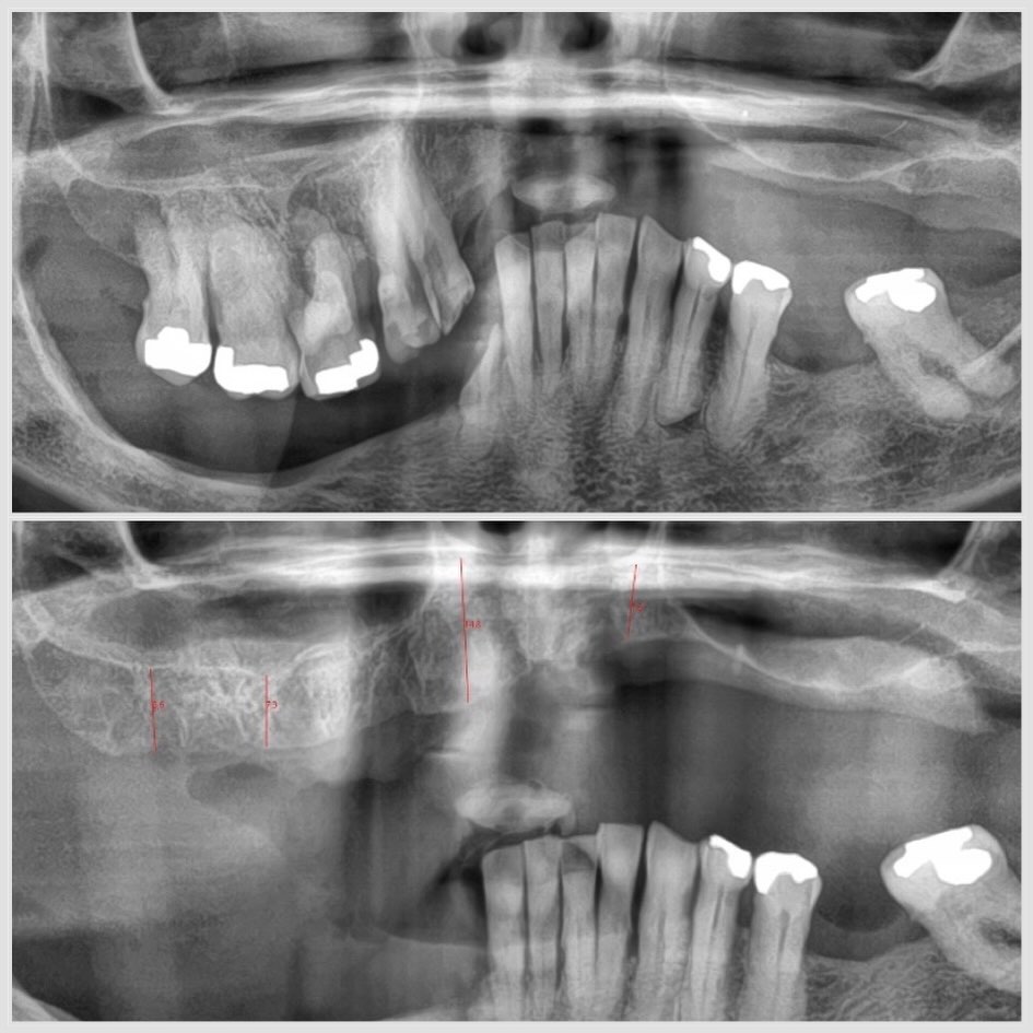 quand un appareil amovible inadapté détruit l os Quand un appareil amovible inadapté détruit l'os Apolline Dental Care | Cabinet Dentaire Spécialisé
