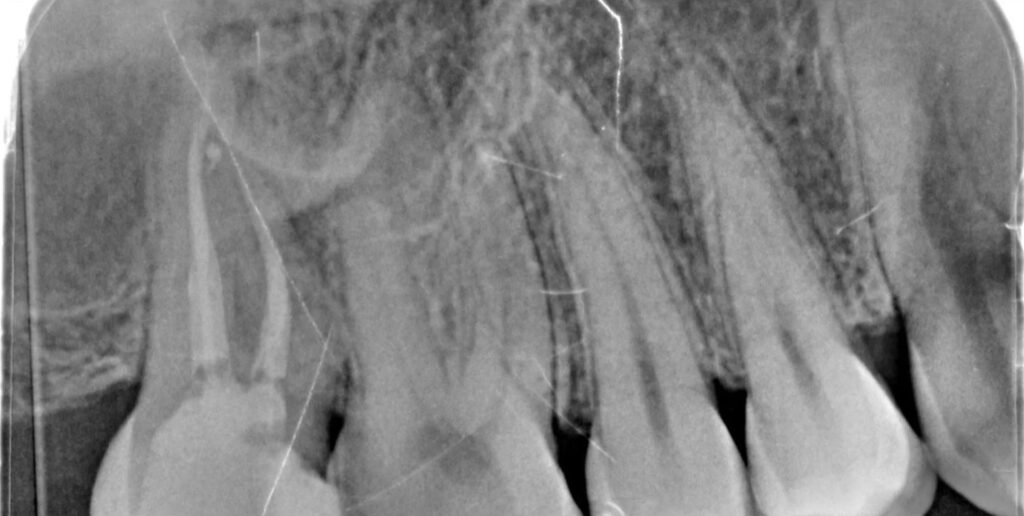 Retraitement endodontique sur molaire maxillaire — cas clinique réalisé au cabinet Apolline Dental Care à Corbeil-Essonnes