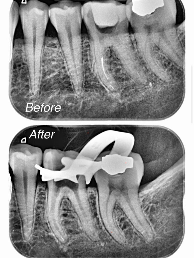 retraitement d une molaire restée douloureuse Retraitement endodontique - Molaire Apolline Dental Care | Cabinet Dentaire Spécialisé