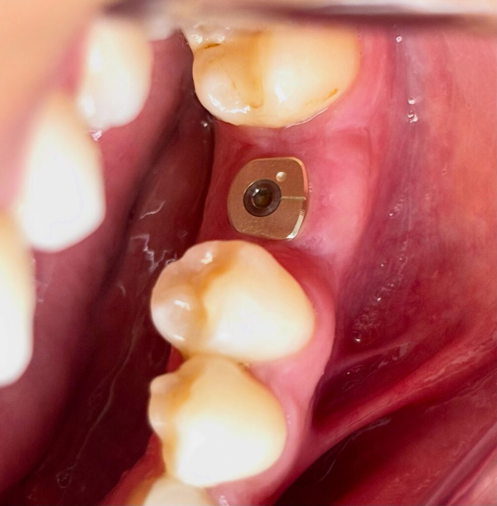secteur molaire gencive avant couronne apolline dental care scaled Secteur molaire : reconstruire la gencive avant la couronne Apolline Dental Care | Cabinet Dentaire Spécialisé