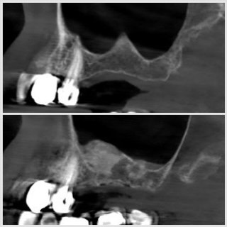 sinus lift en présence d une cloison sinusienne Sinus lift en présence d'une cloison sinusienne Apolline Dental Care | Cabinet Dentaire Spécialisé