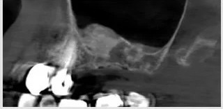 Sinus lift en présence d'une cloison sinusienne — cas clinique realise au cabinet Apolline Dental Care a Corbeil-Essonnes