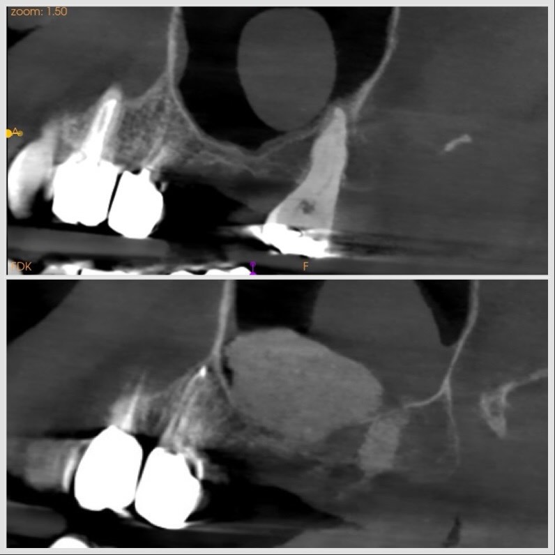 sinus lift et extraction d une dent de sagesse en une séance Sinus lift et extraction d'une dent de sagesse en une séance Apolline Dental Care | Cabinet Dentaire Spécialisé