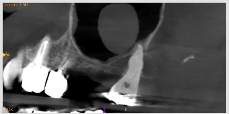 Sinus lift et extraction d'une dent de sagesse en une séance — cas clinique realise au cabinet Apolline Dental Care a Corbeil-Essonnes