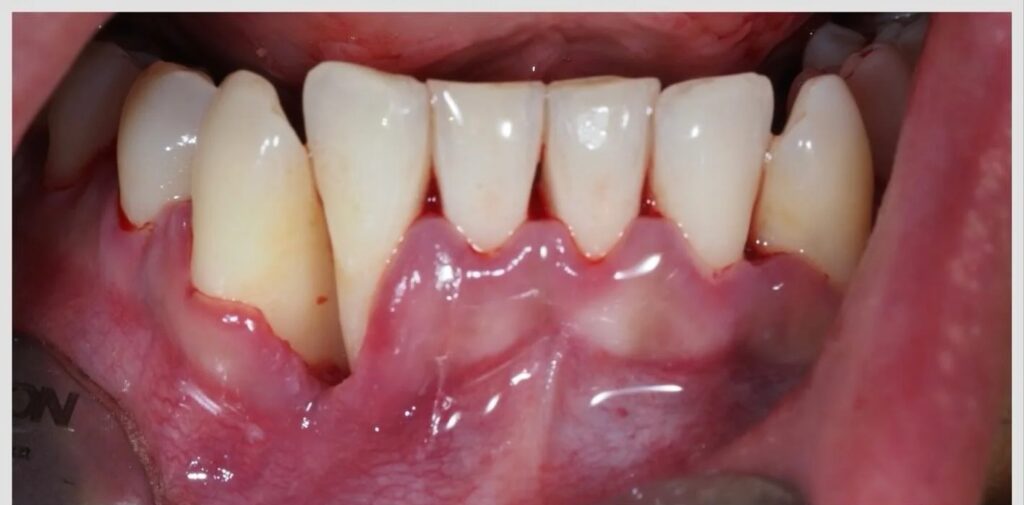 Quand le tabac compromet une greffe gingivale — cas clinique realise au cabinet Apolline Dental Care a Corbeil-Essonnes