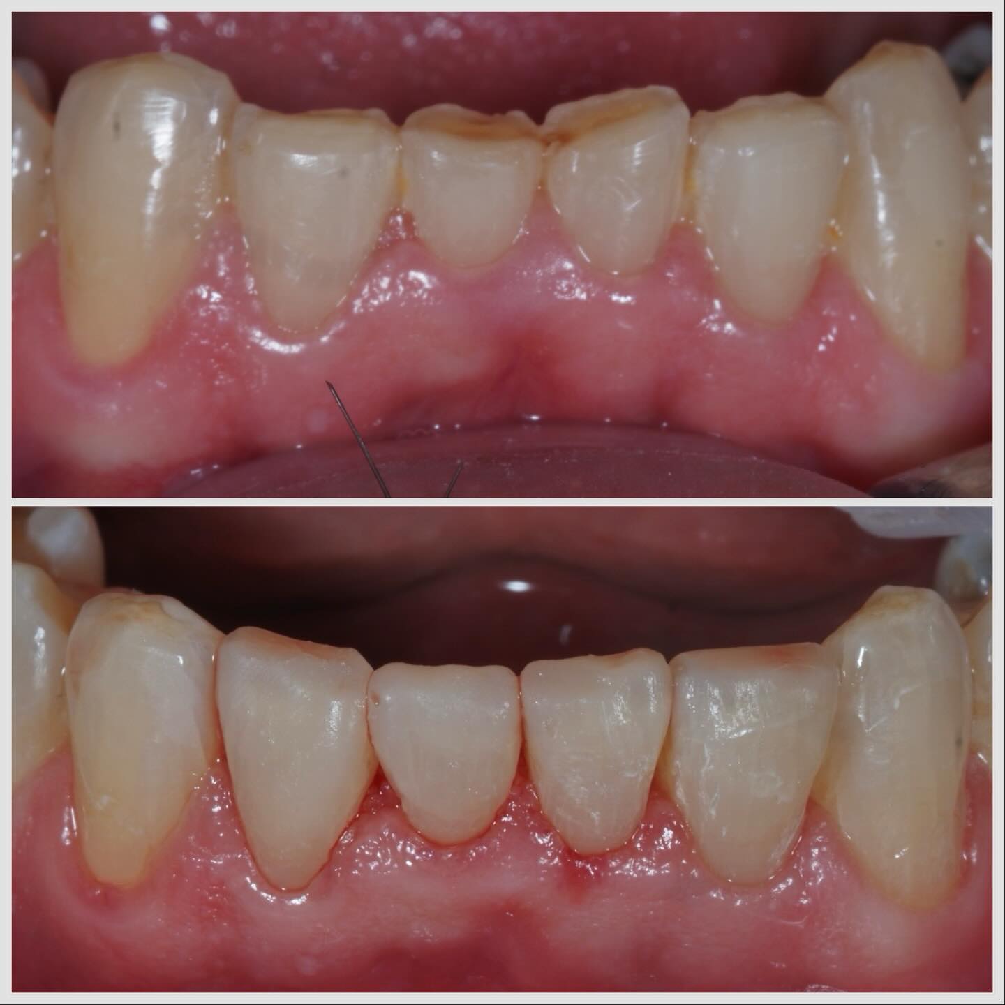 usure des incisives du bas : ingression puis composite injecté usure des incisives du bas : ingression puis composite injecté Usure et Erosion - Composite injecté Apolline Dental Care | Cabinet Dentaire Spécialisé